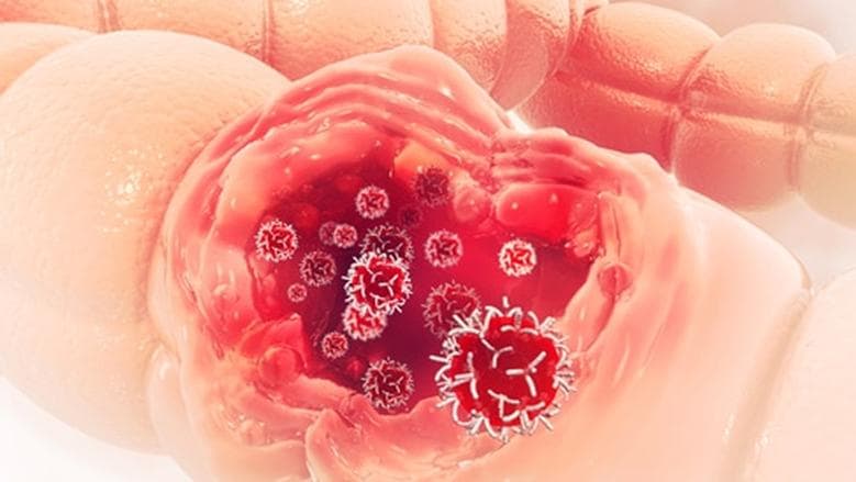 Elyphoza Offers Hope Against Aggressive Cancers
