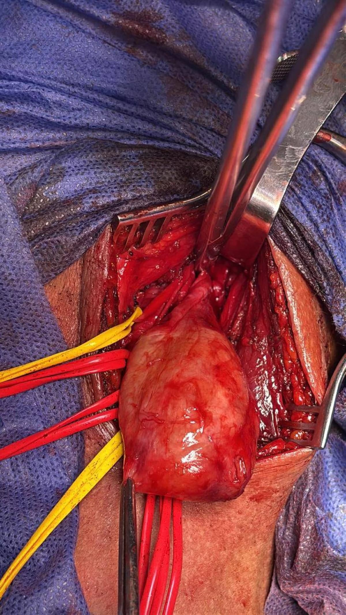Kafr El Sheikh Hospital Treats Carotid Tumor