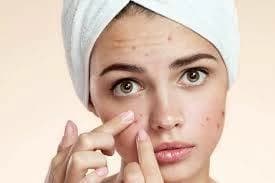 Seven Methods to Remove Blackheads Safely