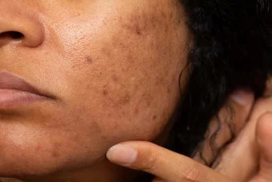 Sun stains in hot weather: 5 skin protection tips