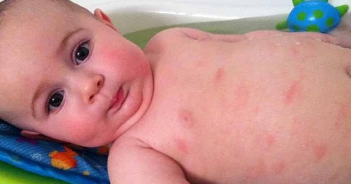 Expert explains skin boil causes