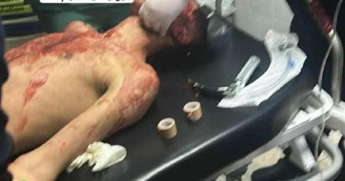 إصابة رأس خطيرة في جباليا