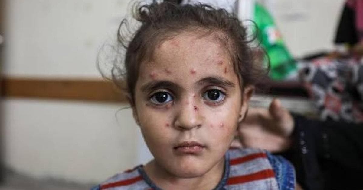 Gaza reports 5,000 measles cases weekly
