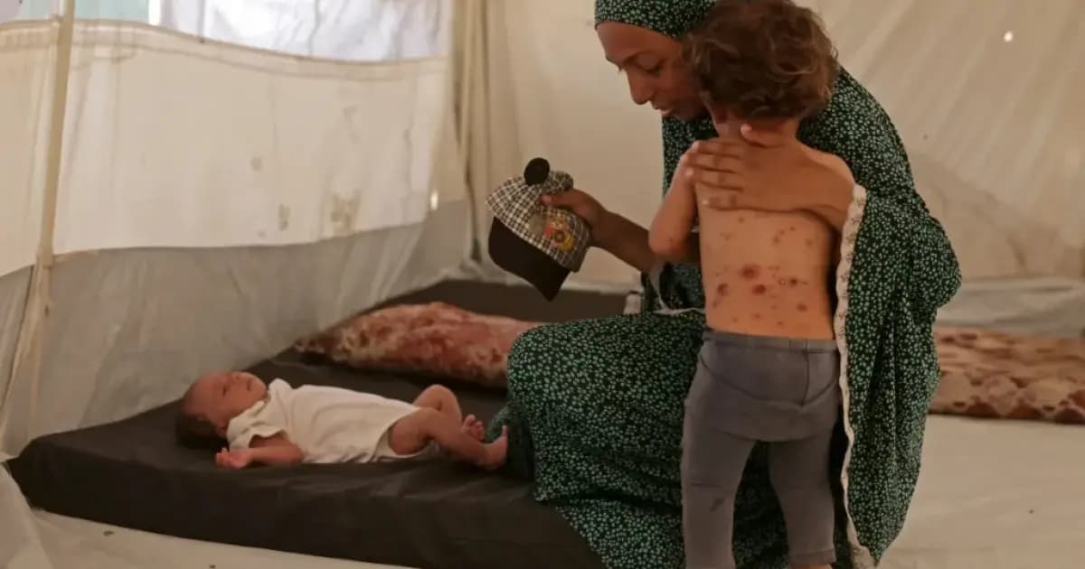 Children face rising chickenpox cases in Gaza