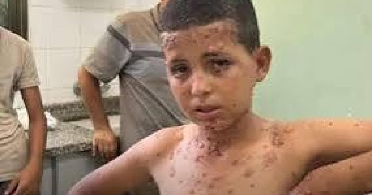 تحذيرات من تفشي وباء جدري الماء بين أطفال غزة