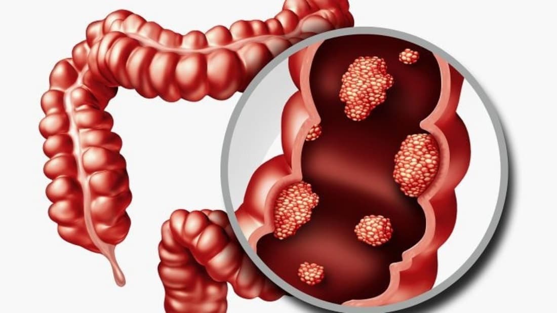 Early Detection Cuts Colorectal Deaths
