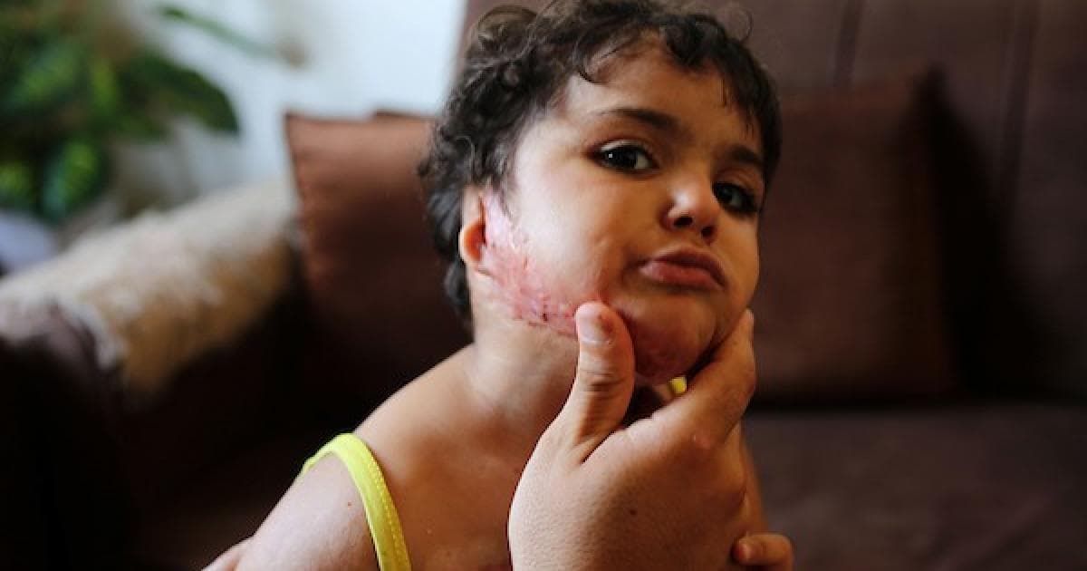 طفلة فلسطينية تتعافى من حروق في غزة