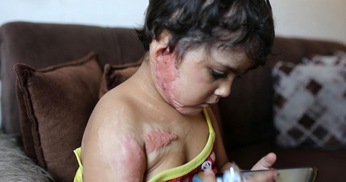 طفلة مصابة بالحروق تنتظر علاجها خارج غزة