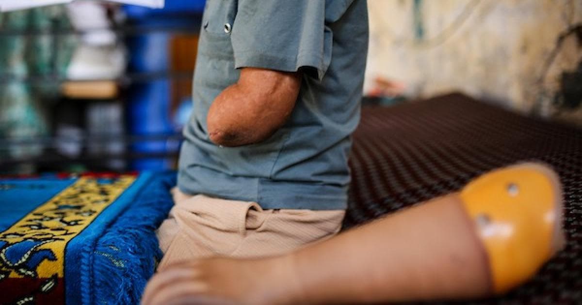 Kanan Shares Photo of Child with Prosthetic Hand from Gaza Airstrike