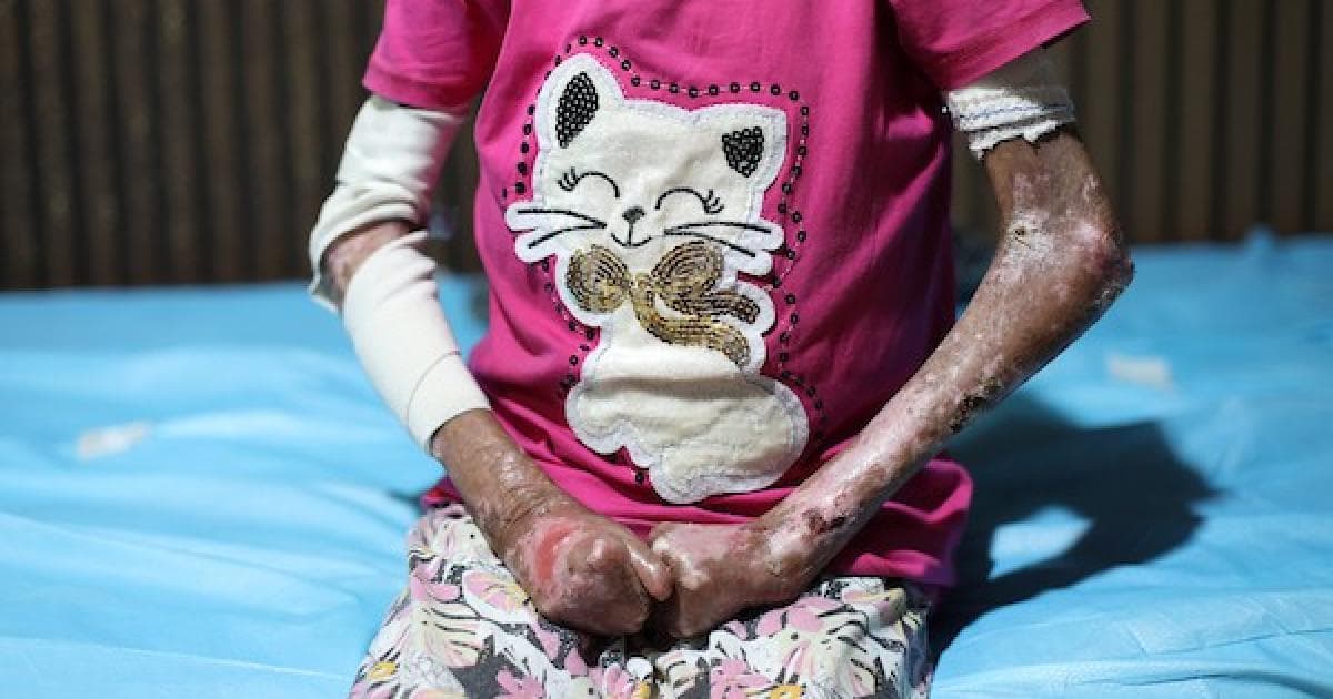 Sondos Battles Skin Disease and Malnutrition in Gaza