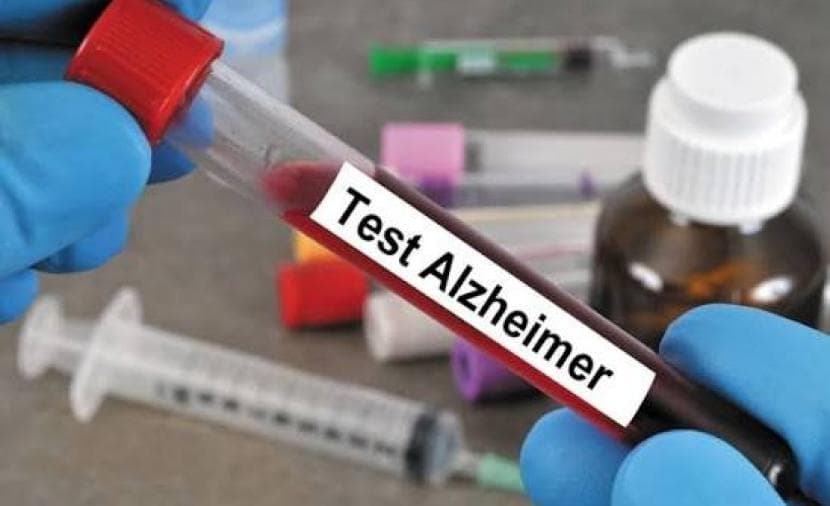 Blood test forecasts Alzheimer's