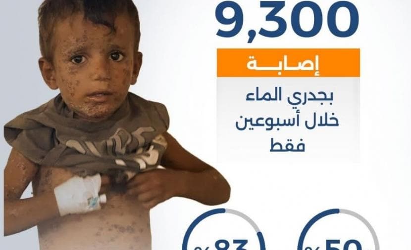 جدري الماء يتفشى بين نازحي غزة خلال الأزمة الإنسانية