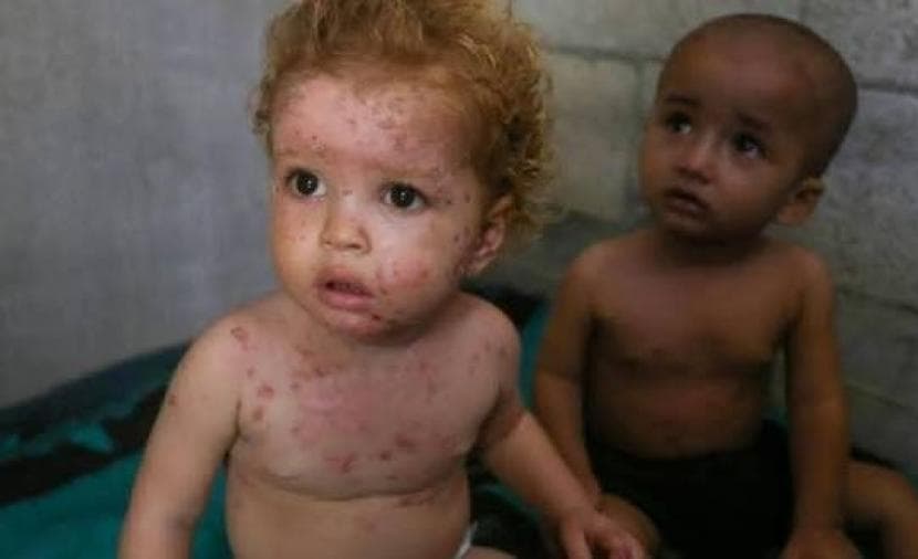 الإغاثة الطبية في غزة تحذر من انتشار وبائي لجدري الماء بسبب نقص اللقاحات
