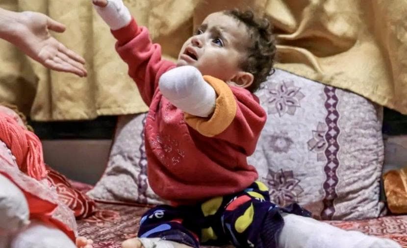 Gaza Amputees Face Complex Injuries