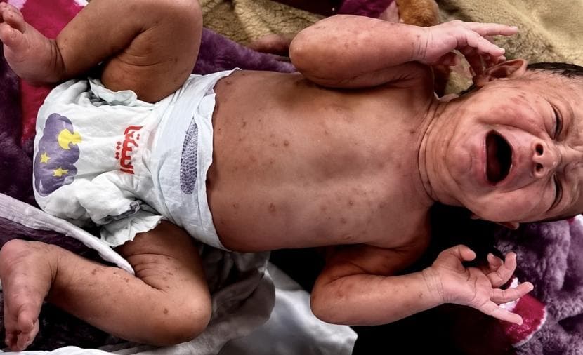 Gaza Chickenpox Outbreak Becomes Crisis