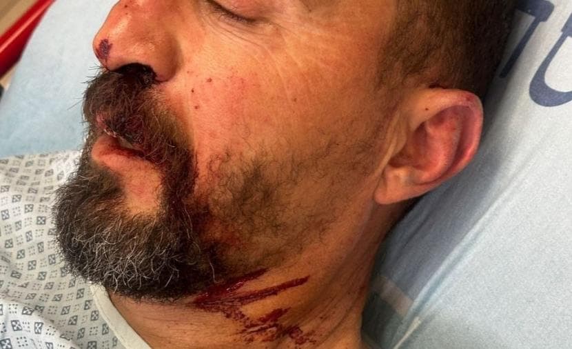 Jerusalemite hurt in Mount Al-Makaber settler attack