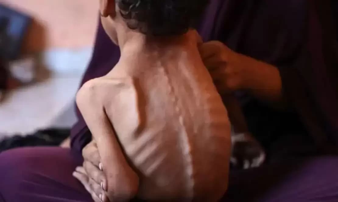 Gaza children still suffer malnutrition