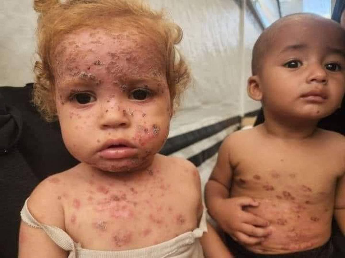 الإغاثة الطبية بغزة تحذر من انتشار وبائي لجدري الماء بين الأطفال بسبب نقص اللقاحات