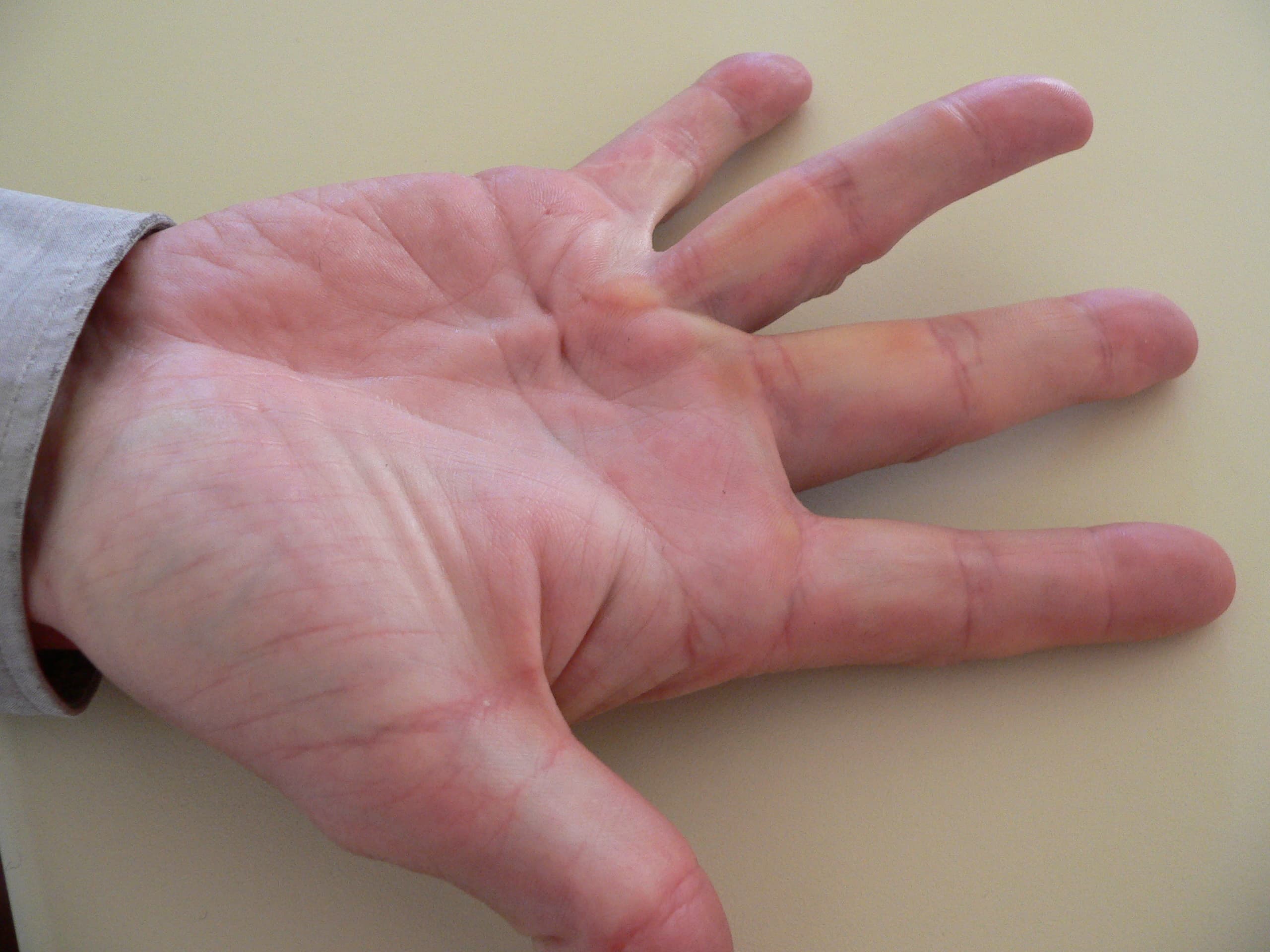 Viking disease causes finger deformities from Neanderthal genes
