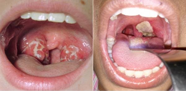 Morocco Urgently Addresses Diphtheria Cases