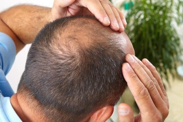هل تصبح علاجات الصلع سوقا بمليارات