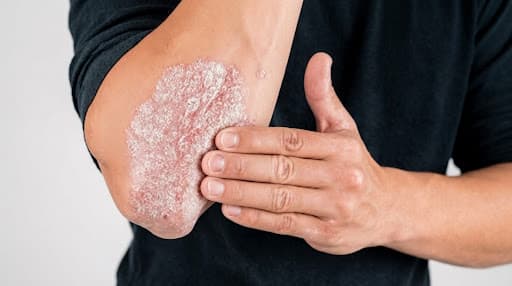 Managing Psoriasis Well