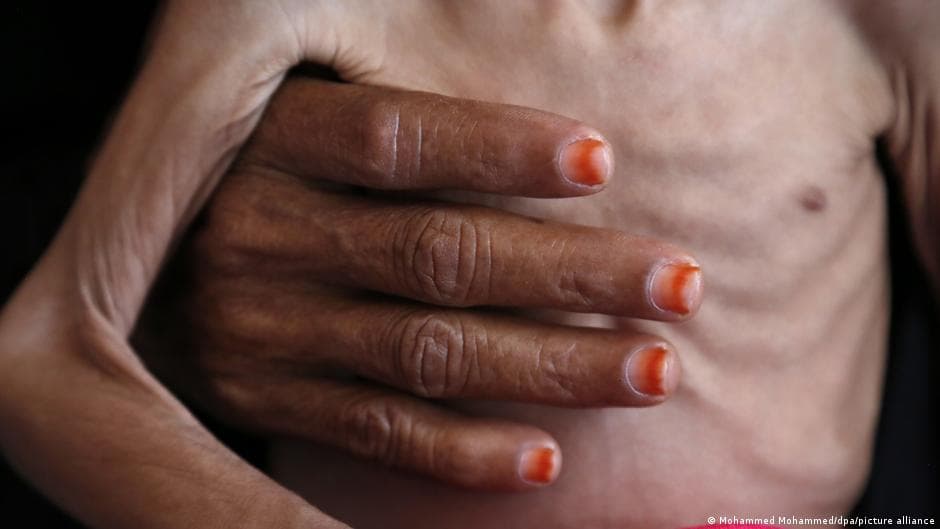 Global Hunger Risks Rise Due to Conflicts and Aid Cuts