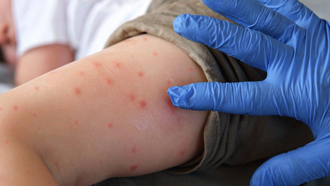 Measles outbreak causes first deaths in 35 years in Northeast