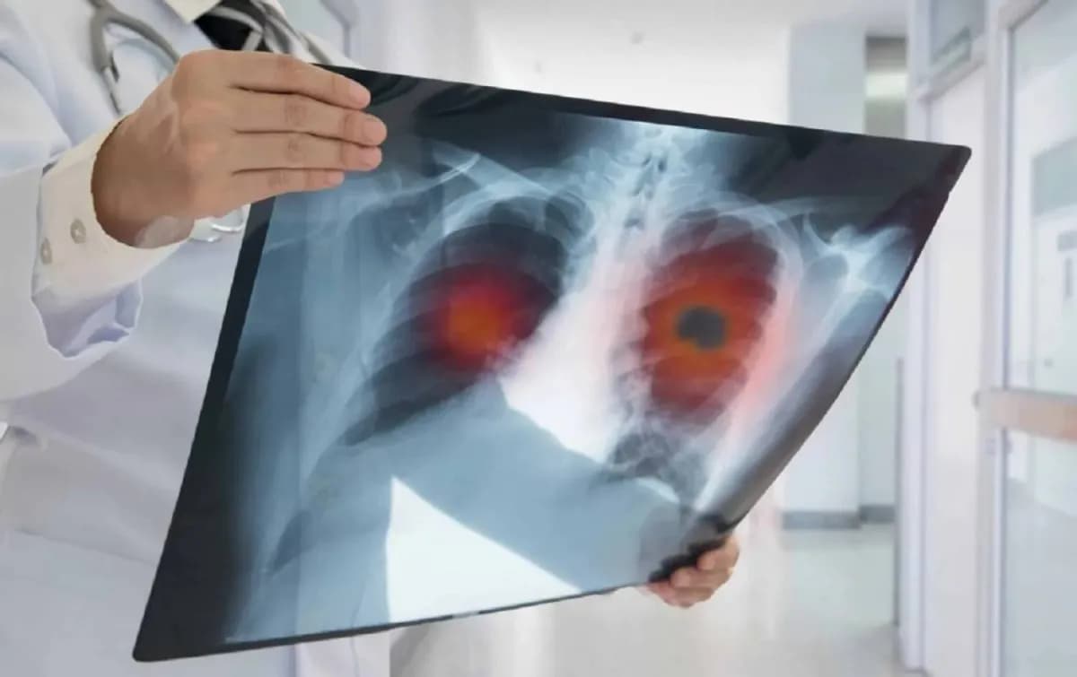 Chemical treatments to aid lung cancer patients