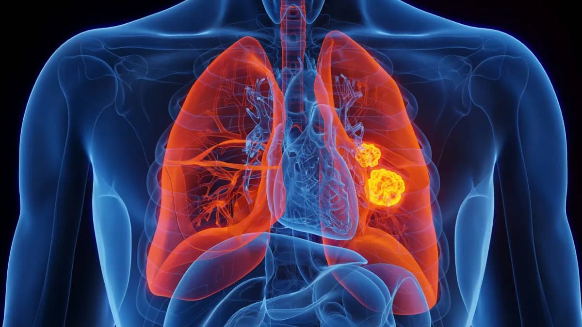 Lung cancer: prevention and early detection