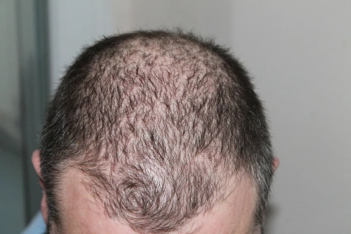 Hair loss progress and recovery