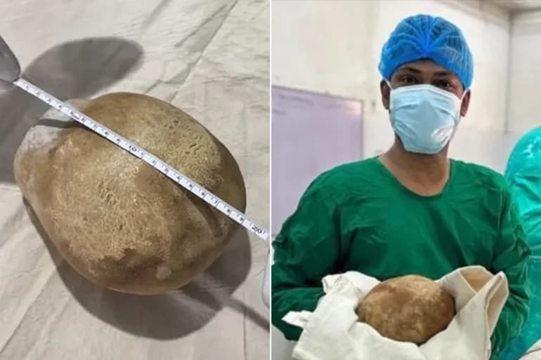 حصوة بحجم طفل في مثانه مدة طويلة