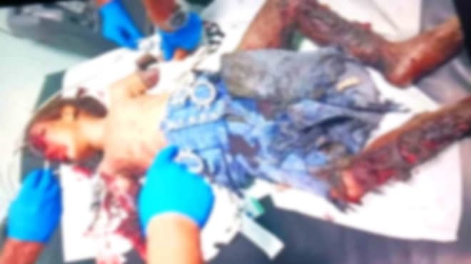 Landmine Ends Young Girl's Life in Al-Dhalee
