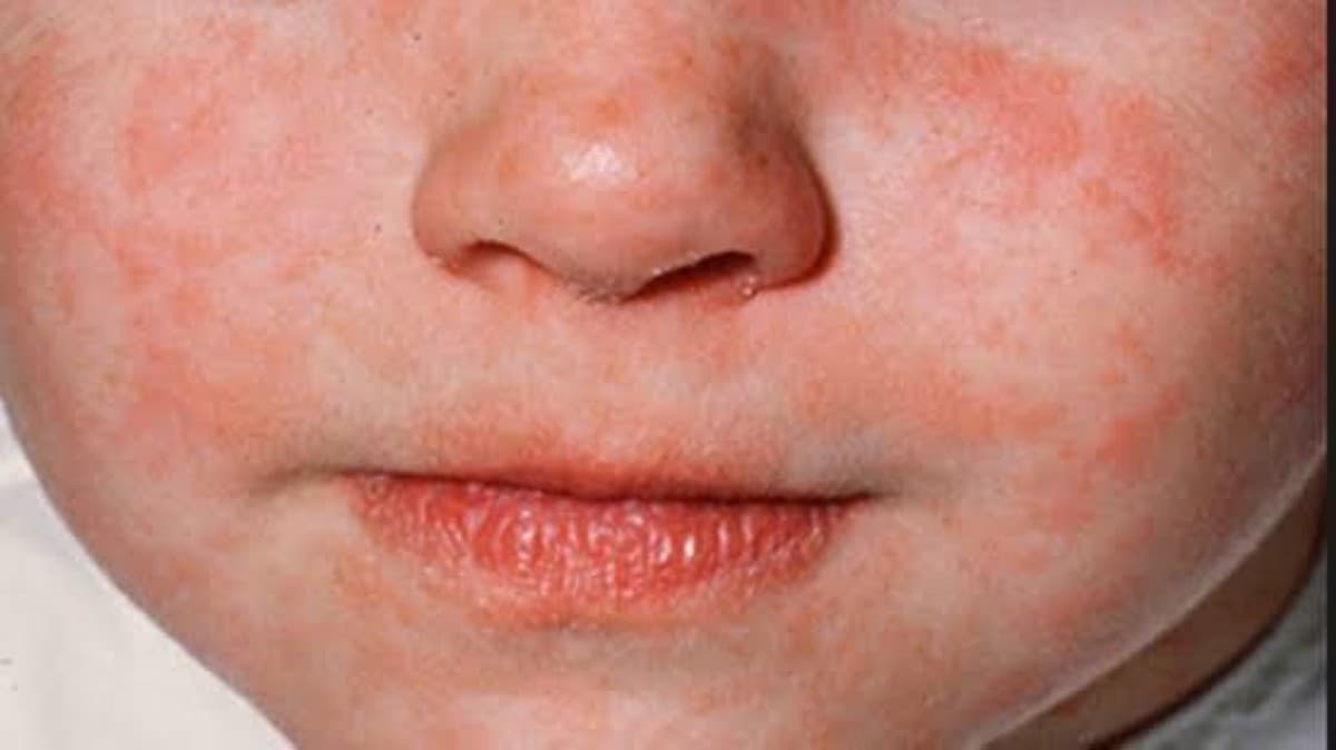 Global measles cases may reach 11 million in 2026