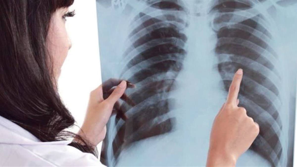 Lung Cancer Screening Results Due in 15 Days