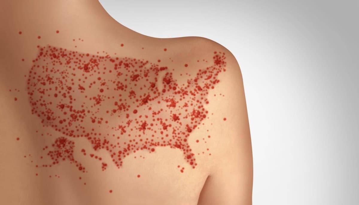 US reports fourth measles death