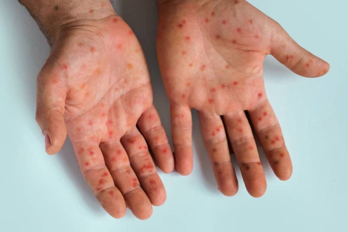 US Measles Cases Exceed 4400
