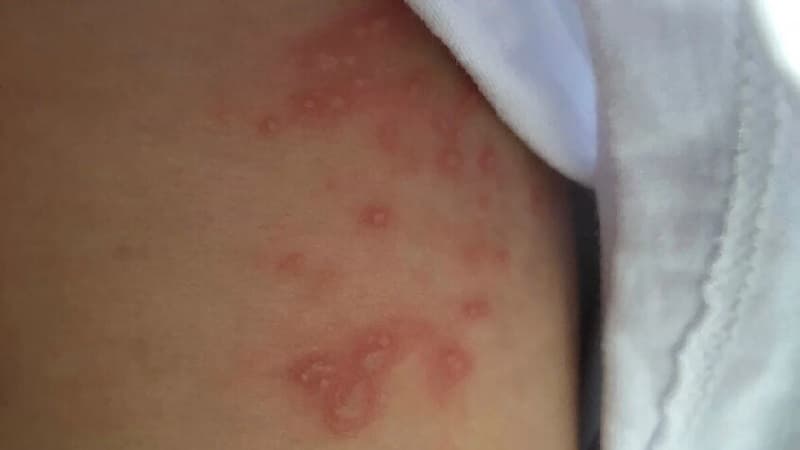 سبب غريب لظهور التقيحات الجلدية