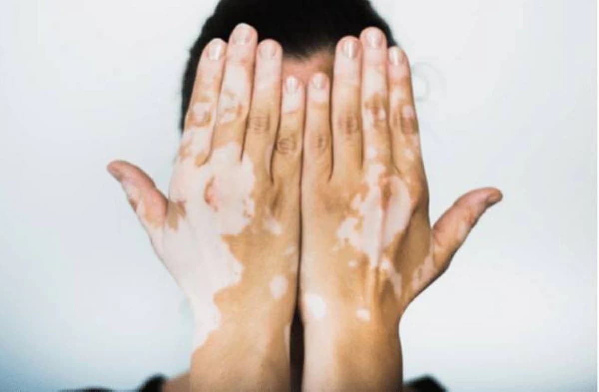New mechanism linked to vitiligo development