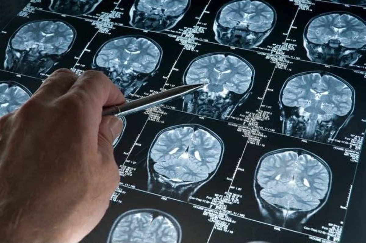بروتين يكشف تلف الدماغ وفرص علاج الزهايمر