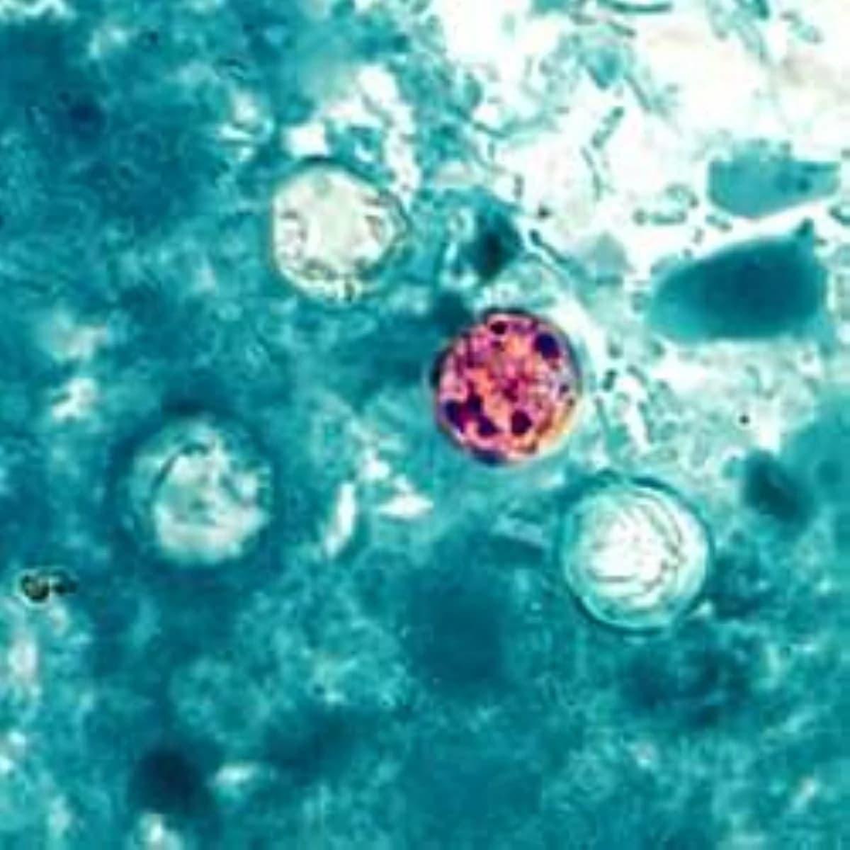 First Cyclospora deaths reported in the US