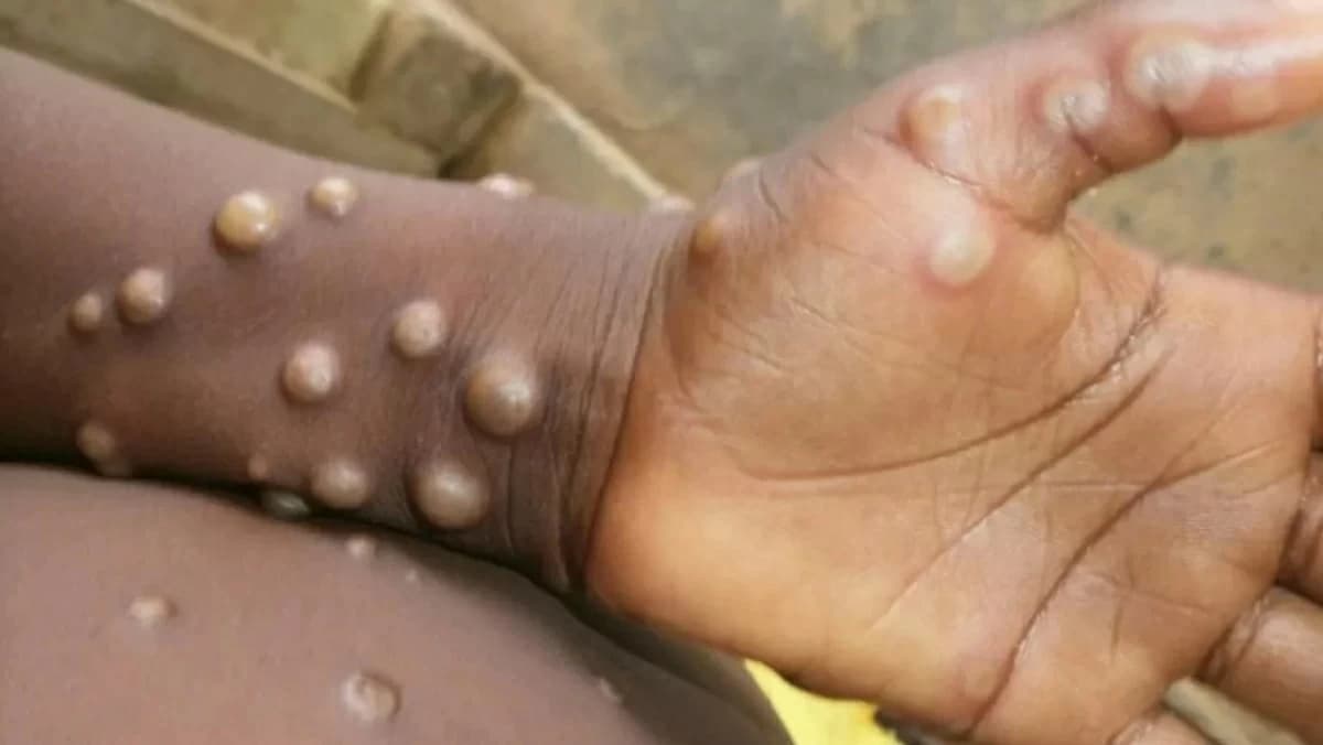 Angola reports 2 deaths and 442 monkeypox cases