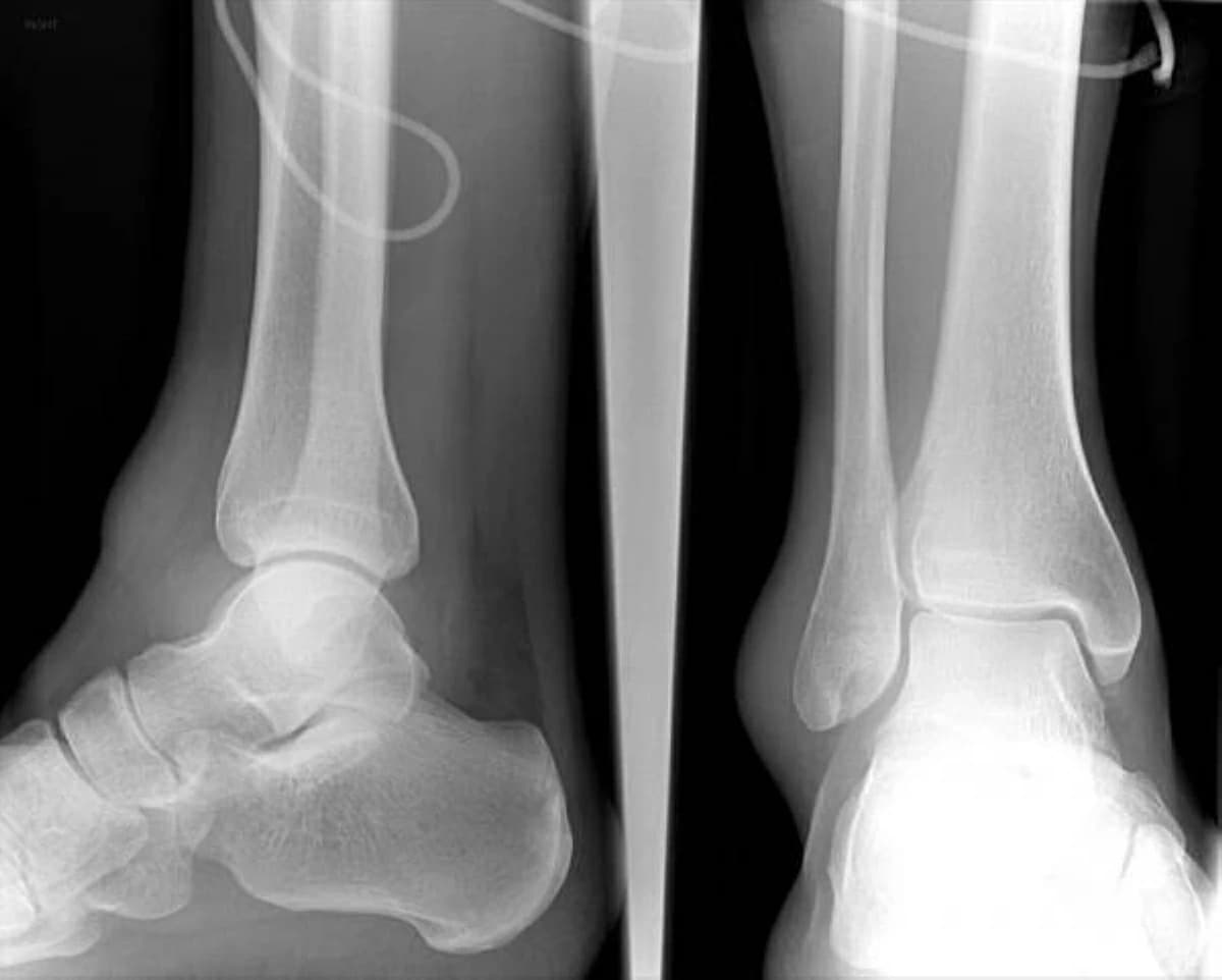 Injection lowers osteoporosis fractures