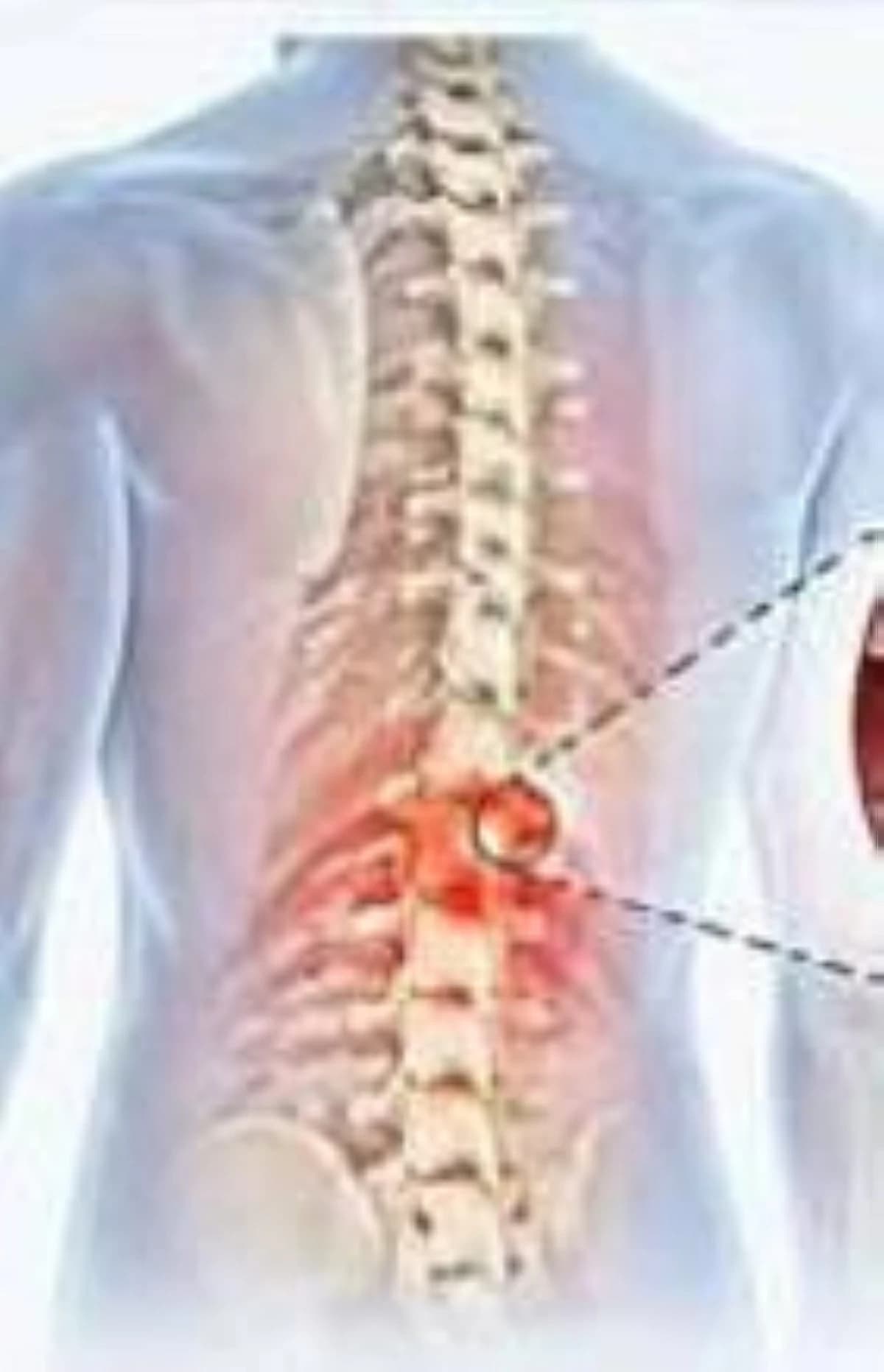 شريحة قابلة للتحلل لعلاج جلطات العمود الفقري