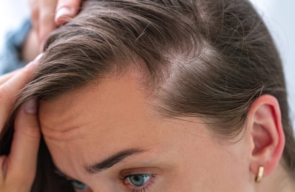 RA medication also treats alopecia