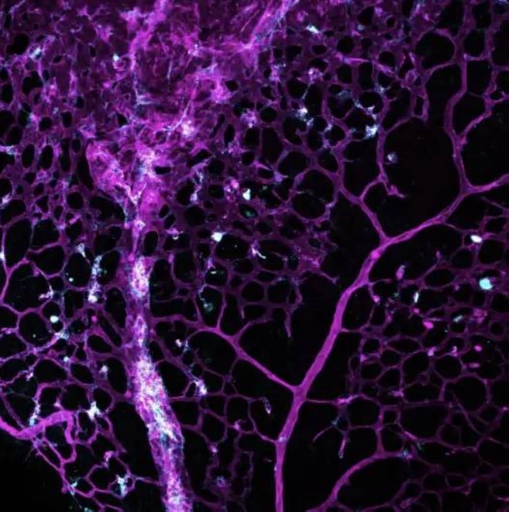 Cancer drug lowers brain vessel issues