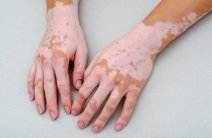 Research suggests activating pigment cells in vitiligo patients