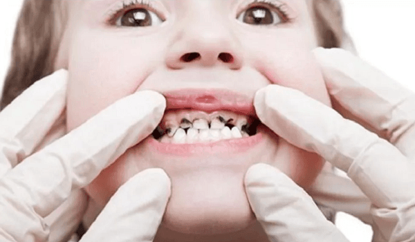 Study: Affordable liquid prevents childhood tooth decay