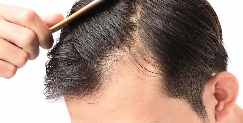 أسباب خفية لتساقط الشعر