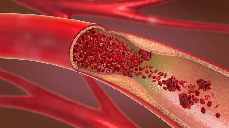 Early Atherosclerosis Signs in Youth